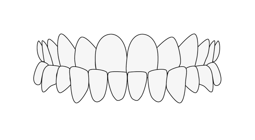 Misaligned Teeth: Head bite new