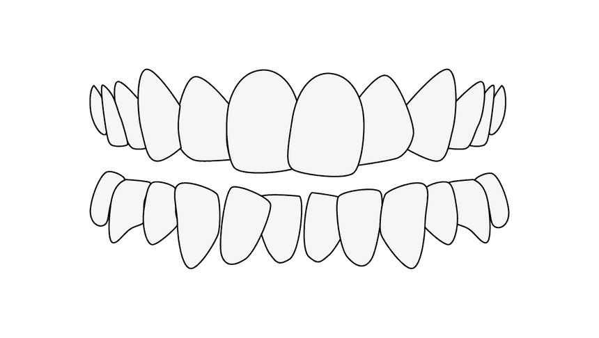 Malocclusion: Teeth misalignment crowding